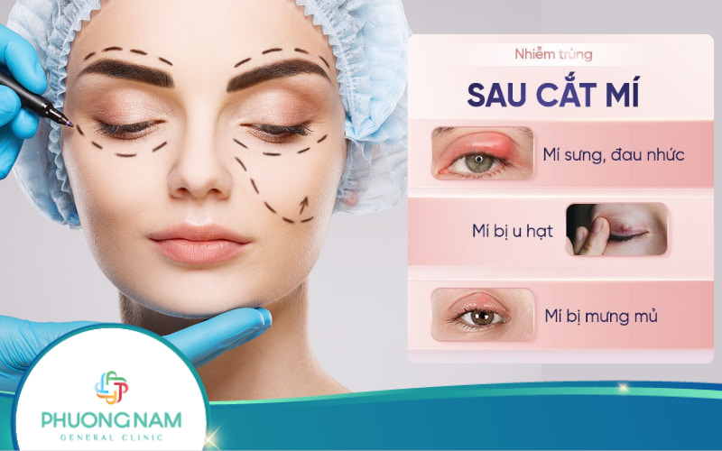 Cắt mí mắt bị nhiễm trùng: Nguyên nhân, điều trị và cách phòng ngừa