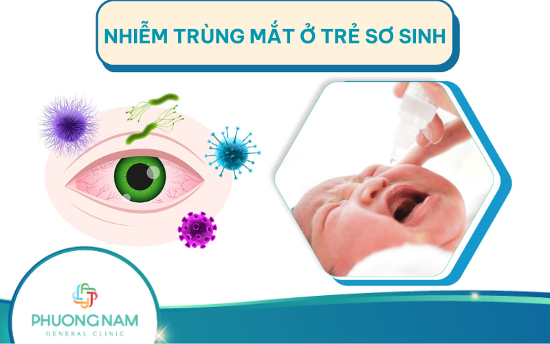 Bệnh nhiễm trùng mắt ở trẻ sơ sinh: Nguyên nhân, nhận biết và điều trị