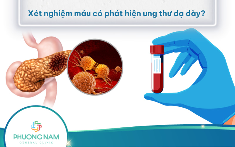 Xét nghiệm máu có phát hiện ung thư dạ dày không? Cần thực hiện xét nghiệm nào?
