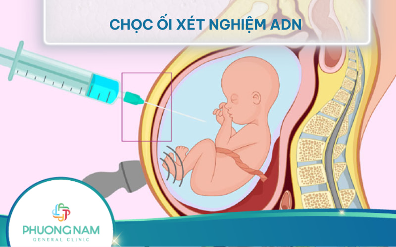 Chọc ối xét nghiệm ADN là gì? Có ảnh hưởng đến thai nhi không?