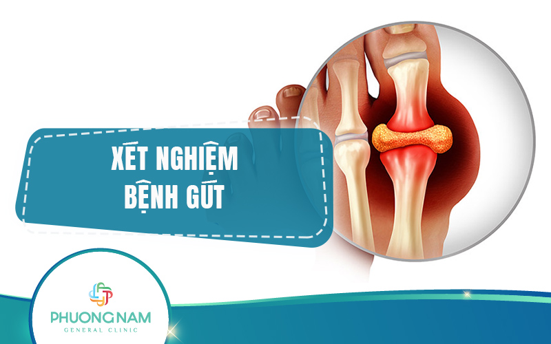 Xét nghiệm bệnh gout: phân loại, quy trình, chi phí và lưu ý