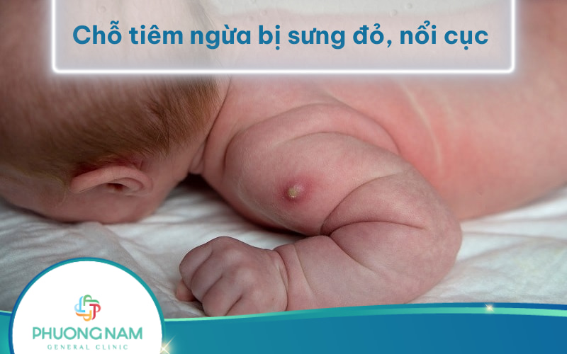 Chỗ tiêm ngừa bị sưng đỏ, nổi cục cứng là bị gì?