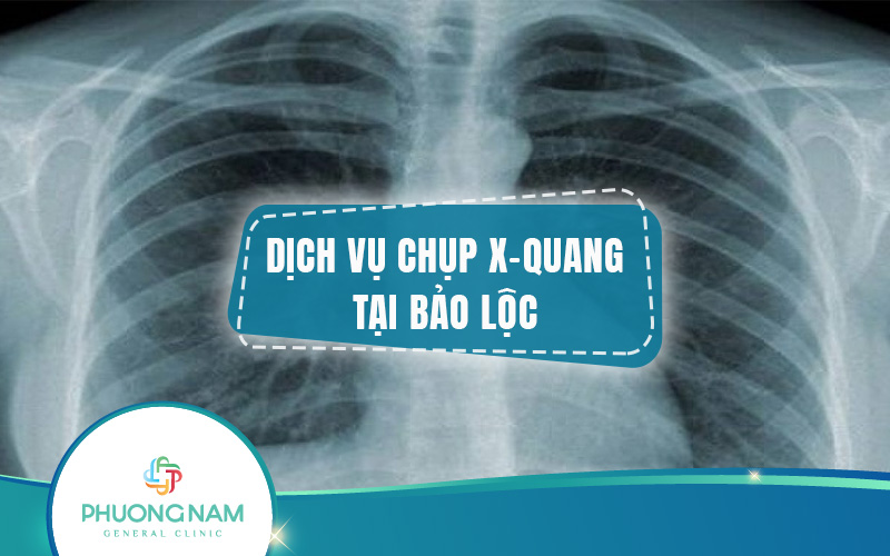 Chụp X-quang Bảo Lộc: Cách phòng ngừa và phát hiện bệnh sớm