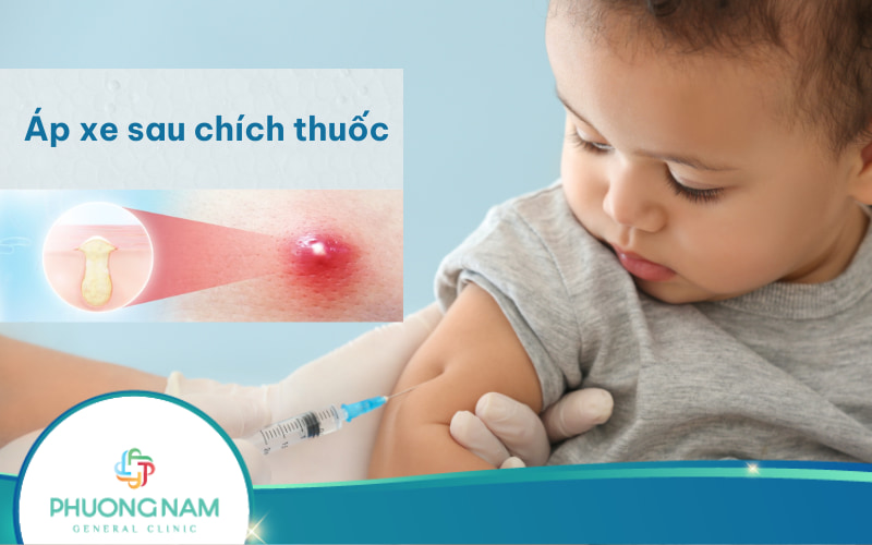 Sau chích thuốc bị áp xe phải làm sao để điều trị hiệu quả và an toàn?