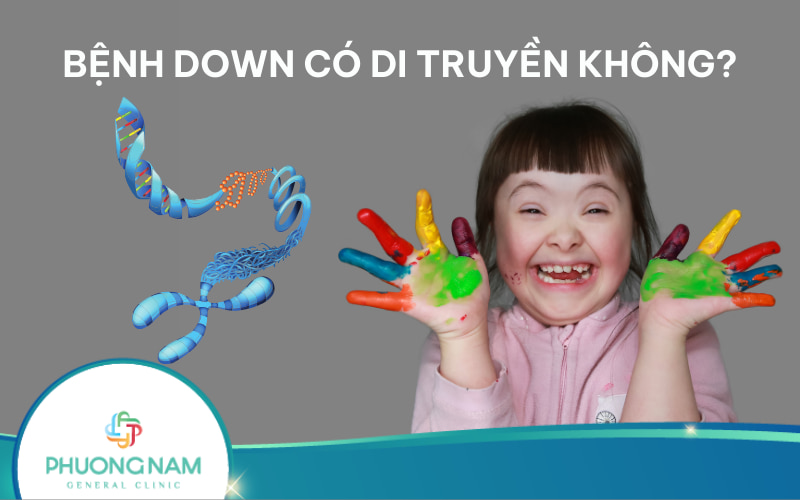 Bệnh Down có di truyền không? Cách phòng ngừa bệnh Down