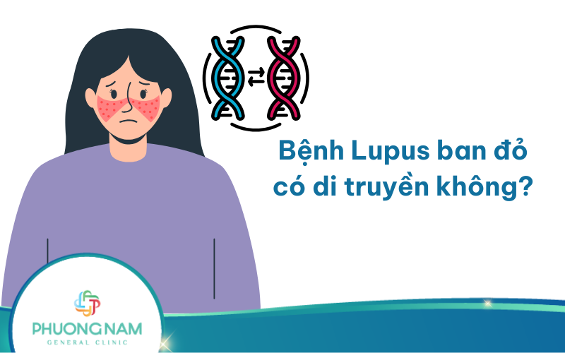 Bệnh Lupus ban đỏ có di truyền không? Nghiên cứu về những nguyên nhân gây bệnh!