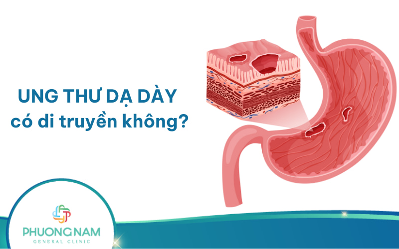 Ung thư dạ dày có di truyền không? Cần làm gì để phòng ngừa?