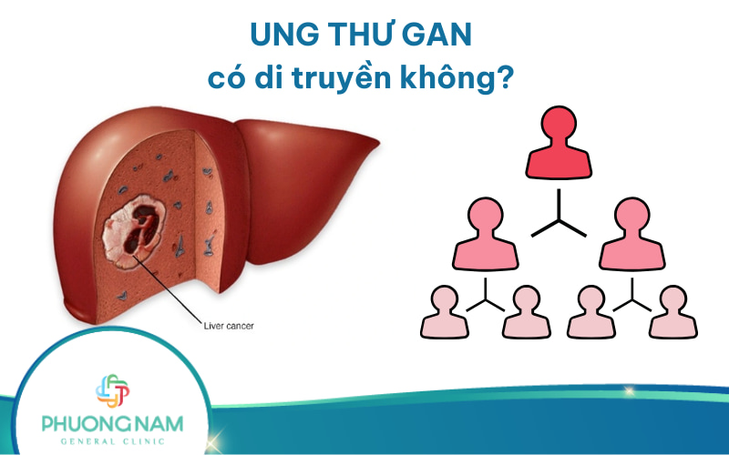 Ung thư gan có di truyền không? Nguyên nhân & cách phòng ngừa bệnh!