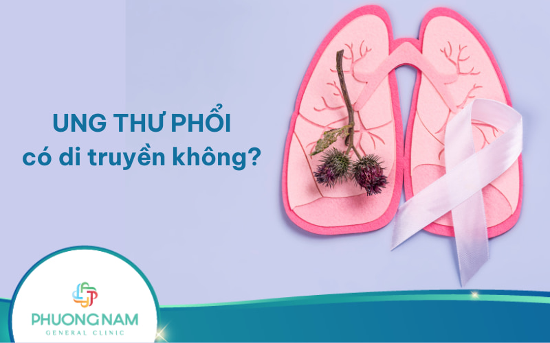 Ung thư phổi có di truyền không? Nguyên nhân & cách phòng ngừa bệnh!