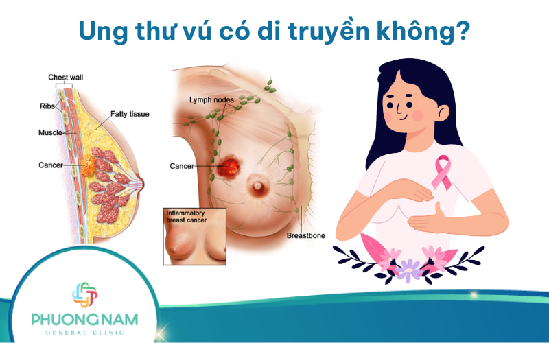 Ung thư vú có di truyền không? Những yếu tố gây bệnh cần chú ý