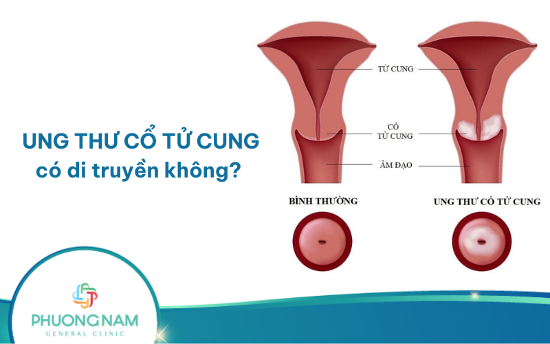 Ung thư cổ tử cung có di truyền không? Cách phòng ngừa bệnh?
