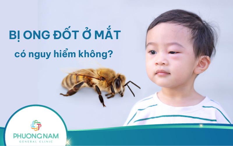 Bị ong đốt ở mắt có nguy hiểm không? Hướng dẫn sơ cứu đúng cách