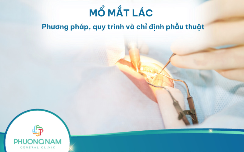 Mổ mắt lác: Chỉ định, phương pháp và quy trình phẫu thuật