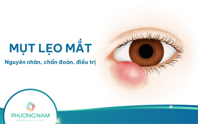 Mụt lẹo mắt là gì? Nguyên nhân, dấu hiệu, điều trị và cách phòng ngừa
