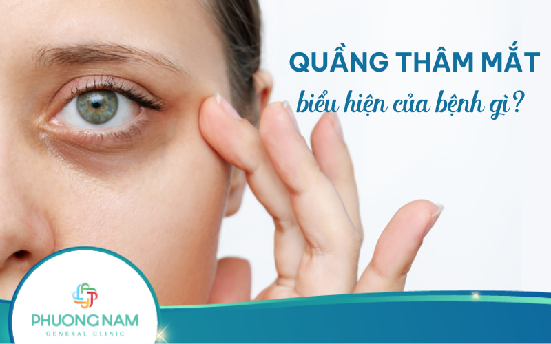 Quầng thâm mắt: Nguyên nhân, cách điều trị và phòng ngừa