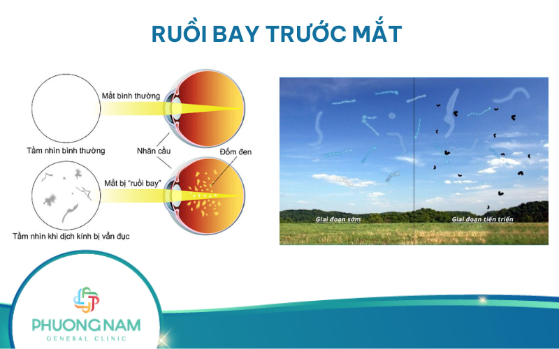 Ruồi bay trước mắt: biểu hiện, nguyên nhân và cách điều trị