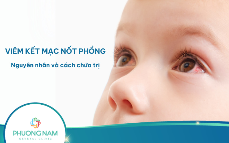 Viêm kết mạc nốt phồng: Nguyên nhân, triệu chứng, cách điều trị