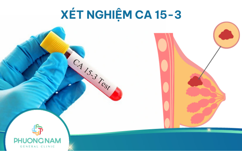 Xét nghiệm CA 15-3: Dấu ấn ung thư vú
