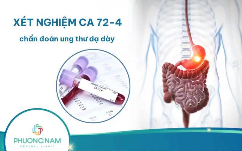 Xét nghiệm CA 72-4 trong chẩn đoán ung thư dạ dày
