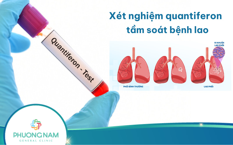 Xét nghiệm QuantiFERON tầm soát bệnh lao