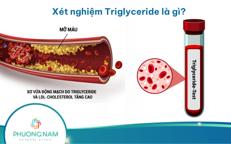 Xét nghiệm Triglyceride là gì? Hướng dẫn cách đọc chỉ số