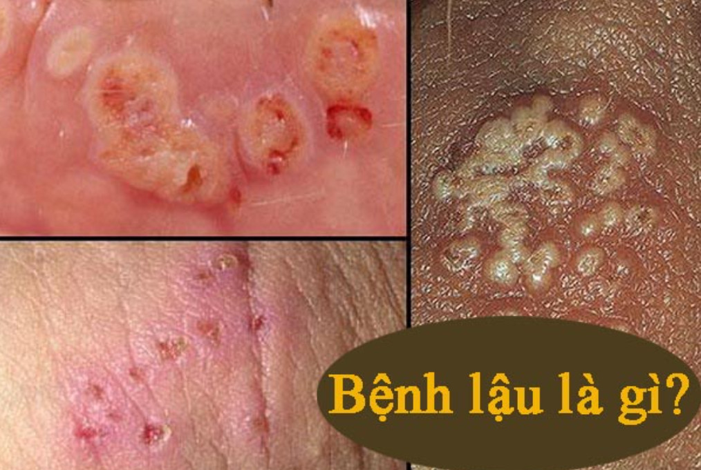 Bệnh Lậu – Kiến Thức Toàn Diện Bạn Cần Biết
