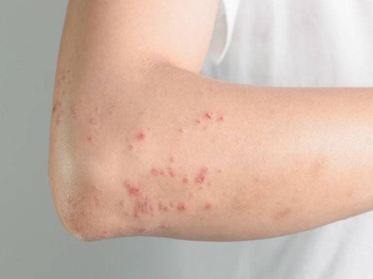 10 Biểu hiện nhiễm ấu trùng giun sán – Triệu chứng và dấu hiệu nhận biết sớm