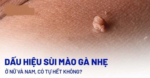 Bệnh sùi mào gà: Toàn bộ thông tin cần biết từ A – Z