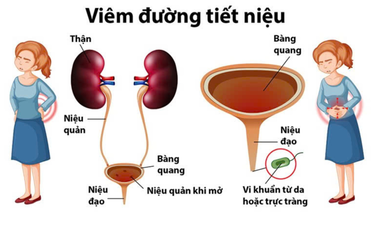 Viêm đường tiết niệu: Nguyên nhân, triệu chứng và cách phòng ngừa