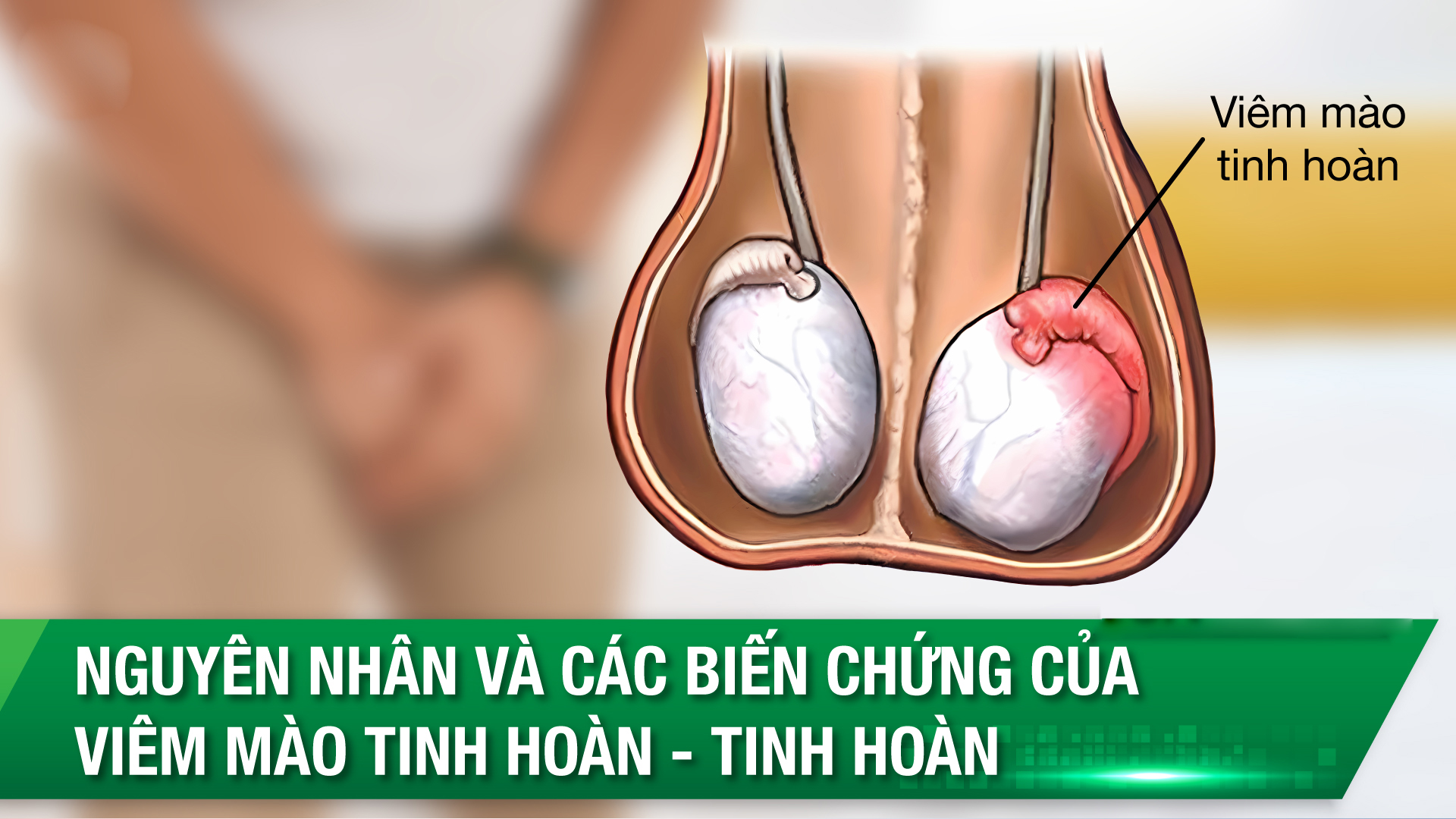 Viêm mào tinh hoàn: Nguyên nhân, Triệu chứng và Cách điều trị hiệu quả