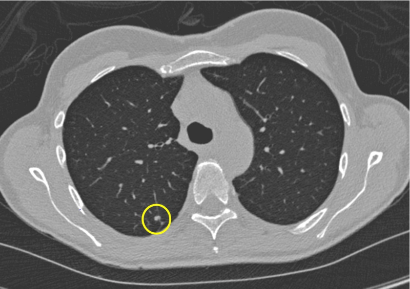 Chụp CT U Phổi: Phương Pháp Chẩn Đoán Chính Xác Giúp Phát Hiện Sớm Ung Thư Phổi