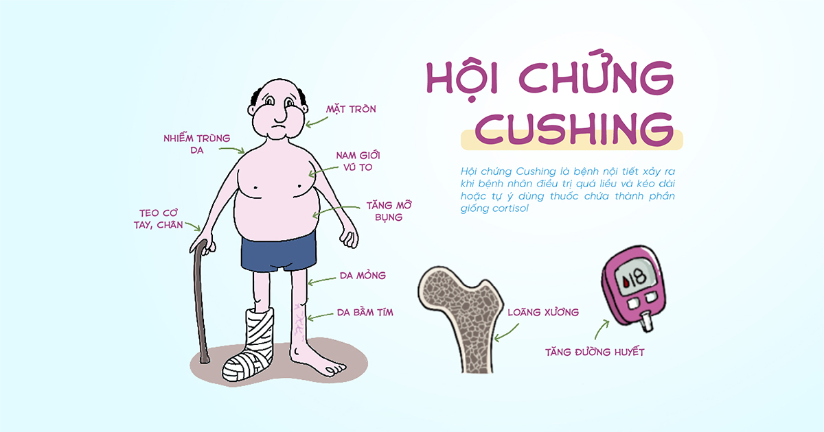 Hội Chứng Cushing: Nguyên Nhân, Triệu Chứng Và Cách Điều Trị Hiệu Quả