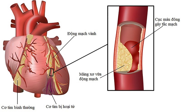 Thiếu máu cơ tim – Nguyên nhân, triệu chứng và cách điều trị hiệu quả