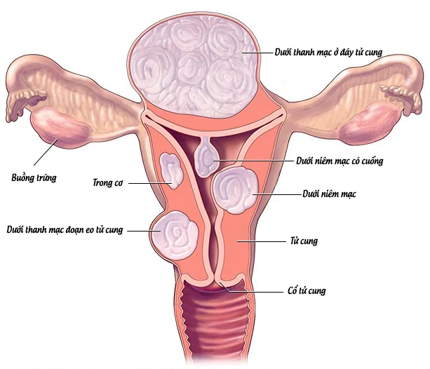 U xơ cổ tử cung: Nguyên nhân, dấu hiệu, biến chứng & phương pháp điều trị hiệu quả tại Phòng khám Đa khoa Phương Nam