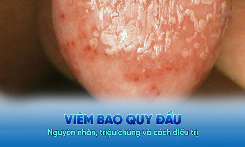 Viêm Bao Quy Đầu Là Gì? Nguyên Nhân, Triệu Chứng Và Cách Điều Trị Hiệu Quả