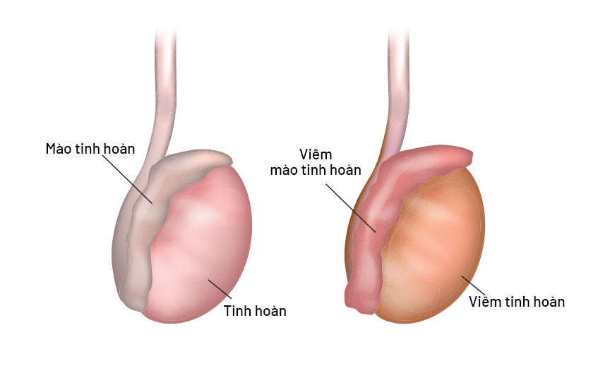 Viêm tinh hoàn: Nguyên nhân, triệu chứng và cách điều trị hiệu quả